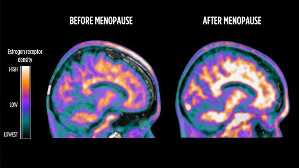 PET scans showing brain estrogen receptor (ER) density in a premenopausal (left) and a postmenopausal (right) woman.