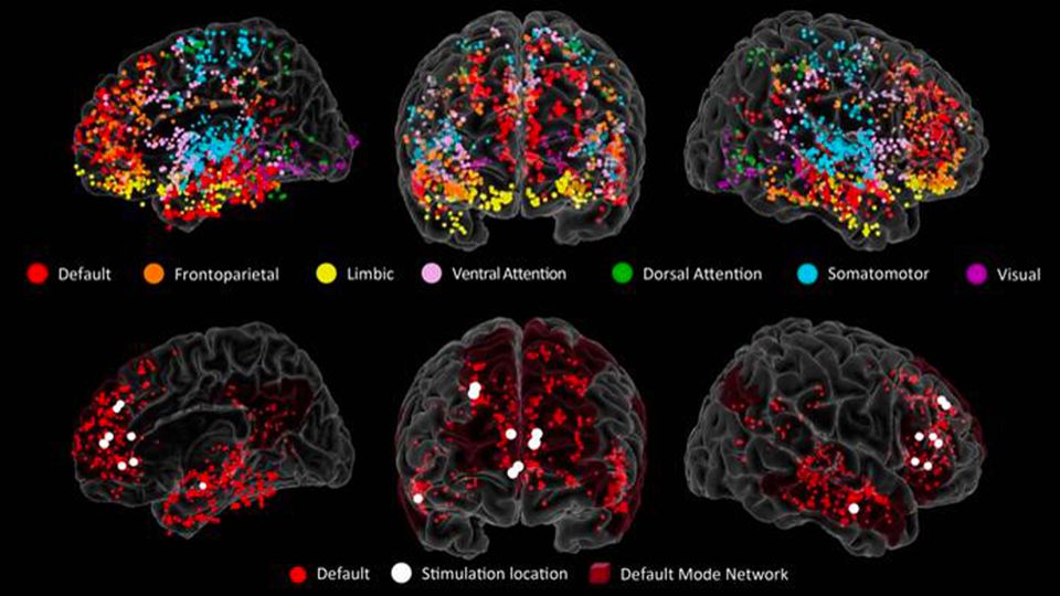 Electrodes at multiple brain regions reveal brain activity in real time.