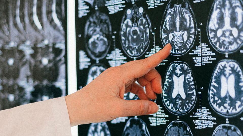 A hand points at a brain scan.