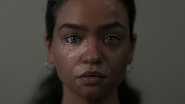 Decayed Skin Loss of Pigment-Producing Cells Linked to Skin Membrane Disruption ...