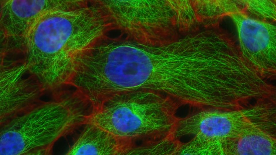 Breast cancer cells, labelled in fluorescent blue, green and red.
