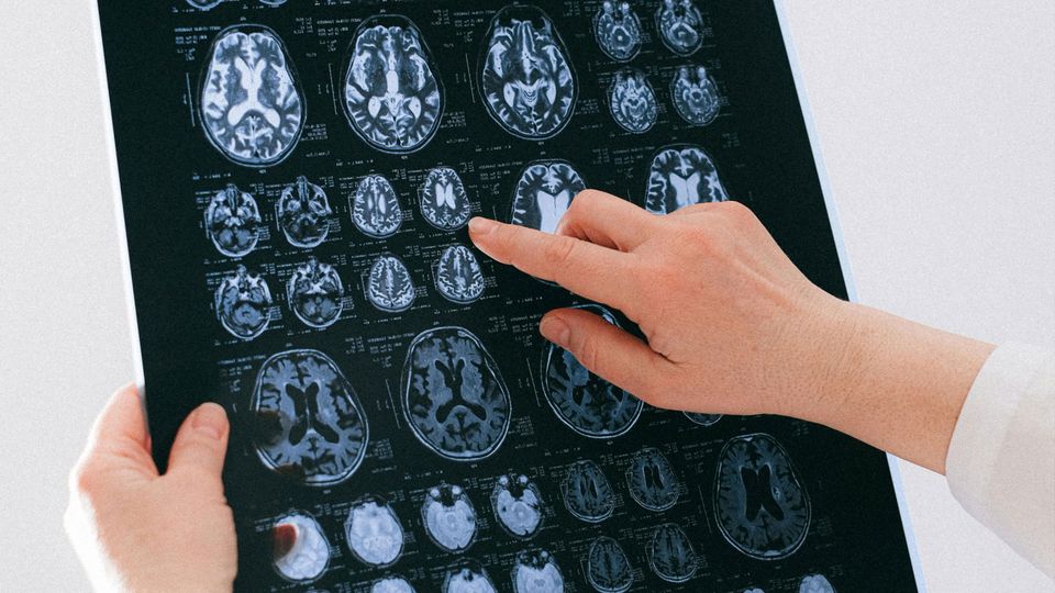 A hand points towards an MRI scan result.