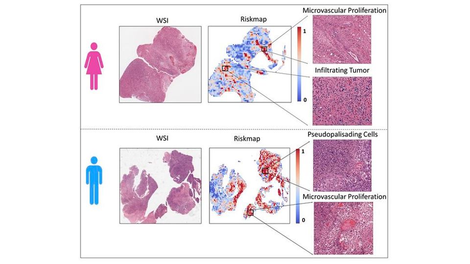 Regions of glioblastoma tumors in females (top) and males (bottom) where the researchers’ AI models predict relatively higher risk and lower risk characteristics are present. Higher risk areas are shown in red and lower risk areas are in blue.