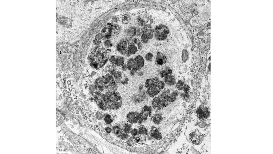 Dark grey blobs form with a neuron.
