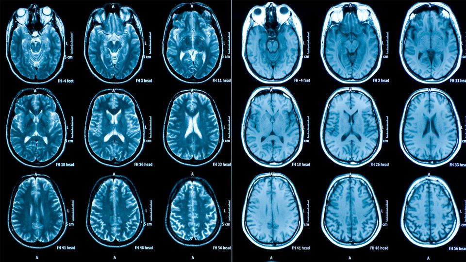 MRI scans of a human brain