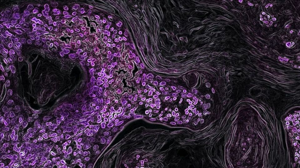 Cancer cells labelled in purple form a cluster against black normal cells.
