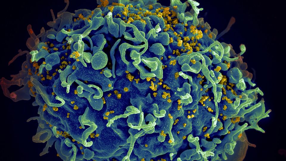 A human cell infected with HIV.