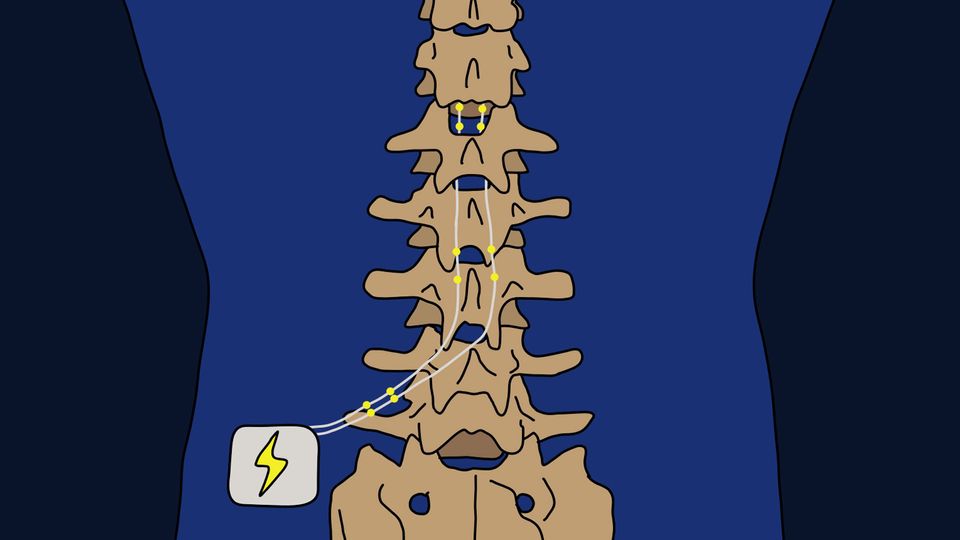 Predicting the Effectiveness of Spinal Cord Stimulation