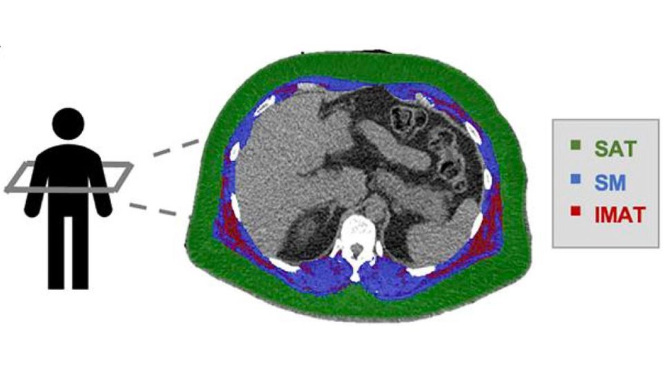 Researchers used CT scans to analyse each patient’s body composition, measuring the amounts and location of fat and muscle in a section of their torso.