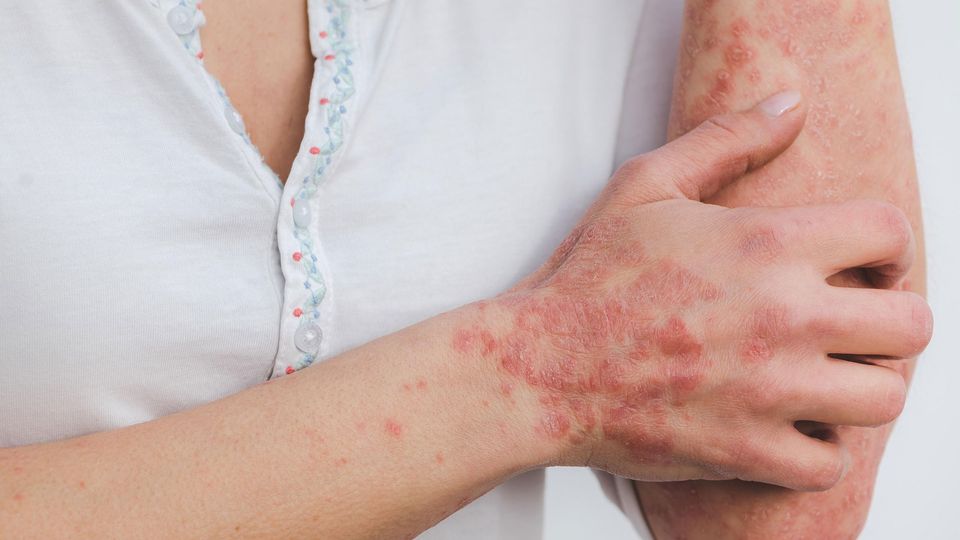Woman with psoriasis