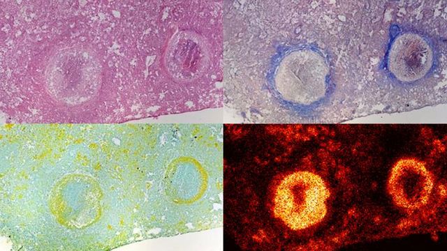 Four images showing layers of different cells and tissues in granulomas, with the fourth showing how the new antibiotic accumulates.