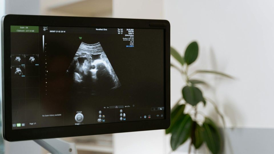 A computer screen with an ultrasound image of a fetus in utero.