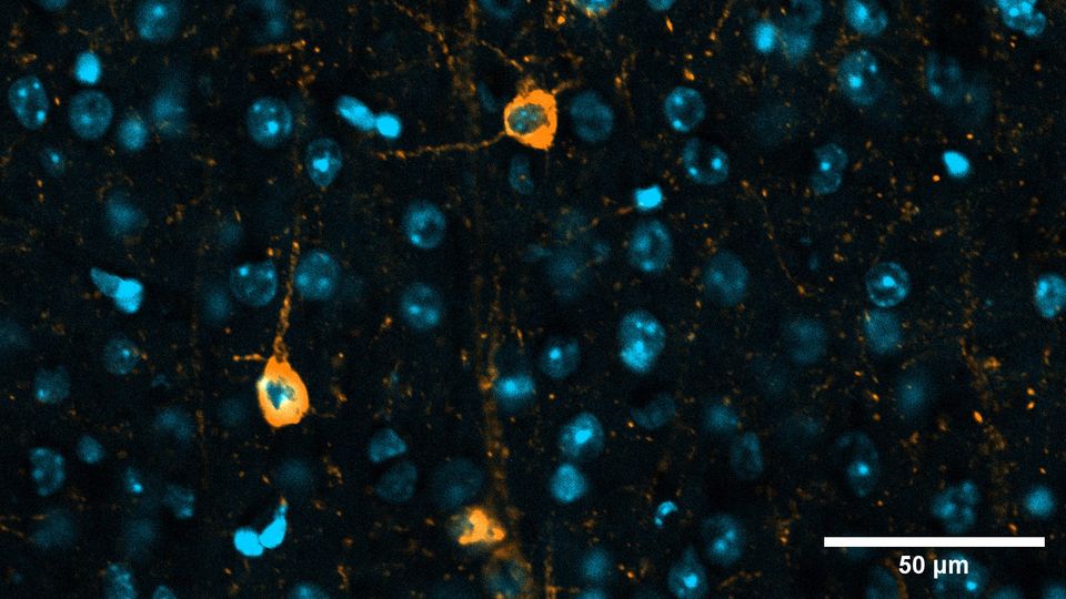 Tau protein in the brain of a mouse with a mutation that causes a common form of dementia.