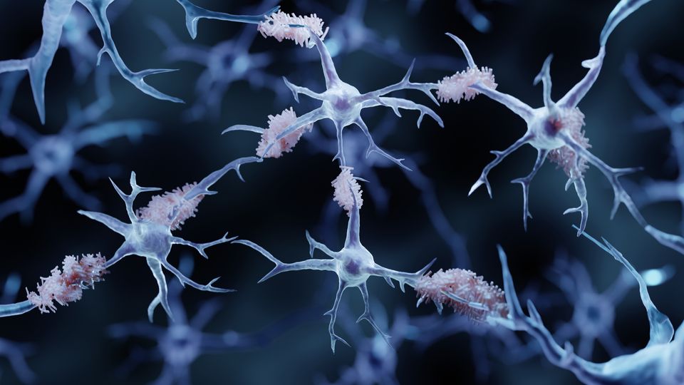 Neurons with amyloid plaques, which are implicated in Alzheimer's disease pathology.