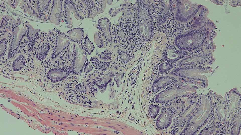Standard tissue staining of a mouse intestine demonstrating robust inflammation in the absence of ILC3-specific STING.
