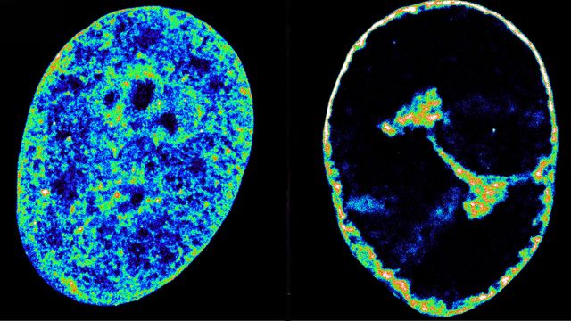 Human DNA in its natural state inside cells (left) compared to eight hours after being infected with HSV-1 (right).
