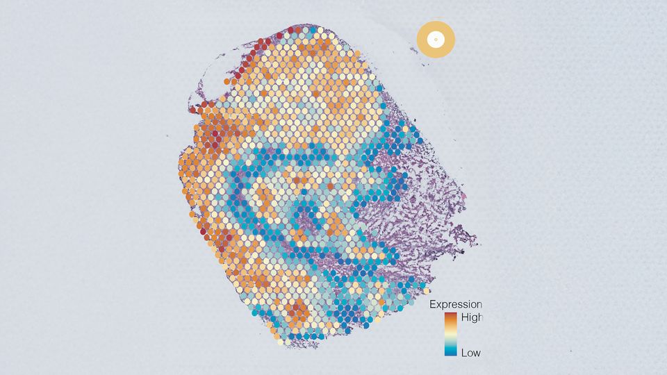 Tumour cross section showing five cell groups, each coloured differently based on gene expression.