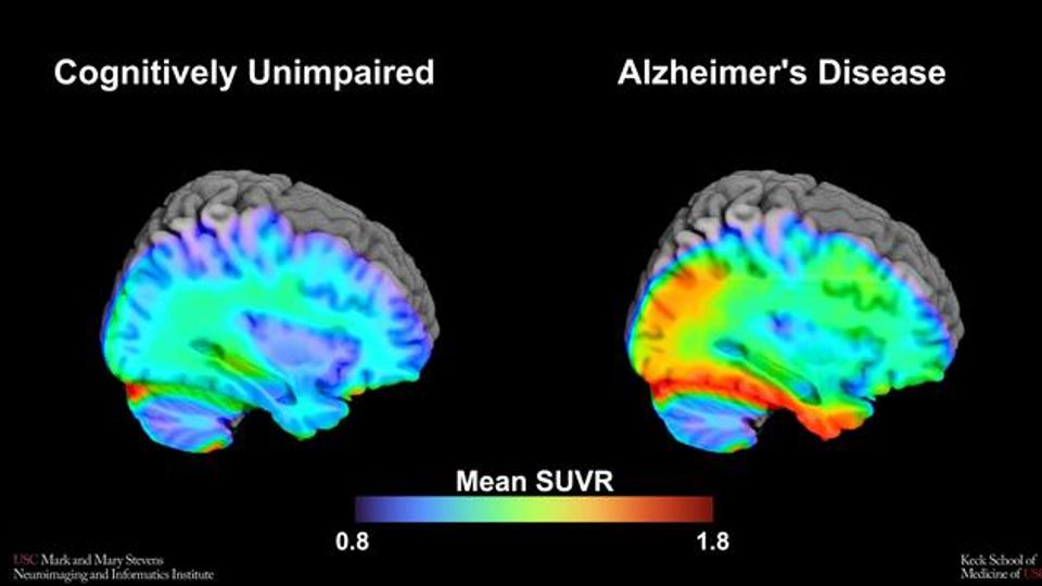 Brain scans comparing tau buildup in cognitively unimpaired individuals and Alzheimer's patients.