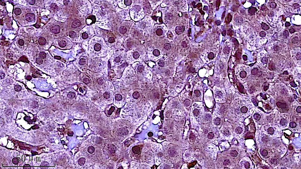 Interleukin 33 (brown) upregulation in hepatitis B virus-positive chronic hepatitis.