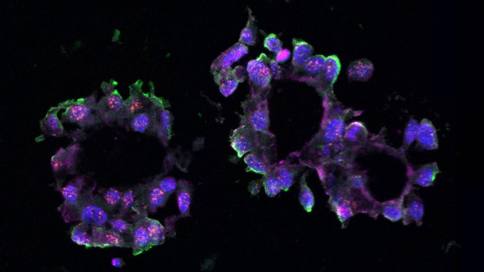 This triple-negative breast cancer organoid was grown in the lab using tissue samples donated by a volunteer patient. LINC01235 is seen in red.