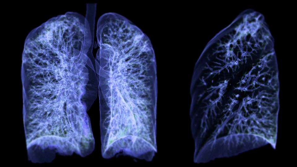 A scan image of a set of lungs in blue on a black background.