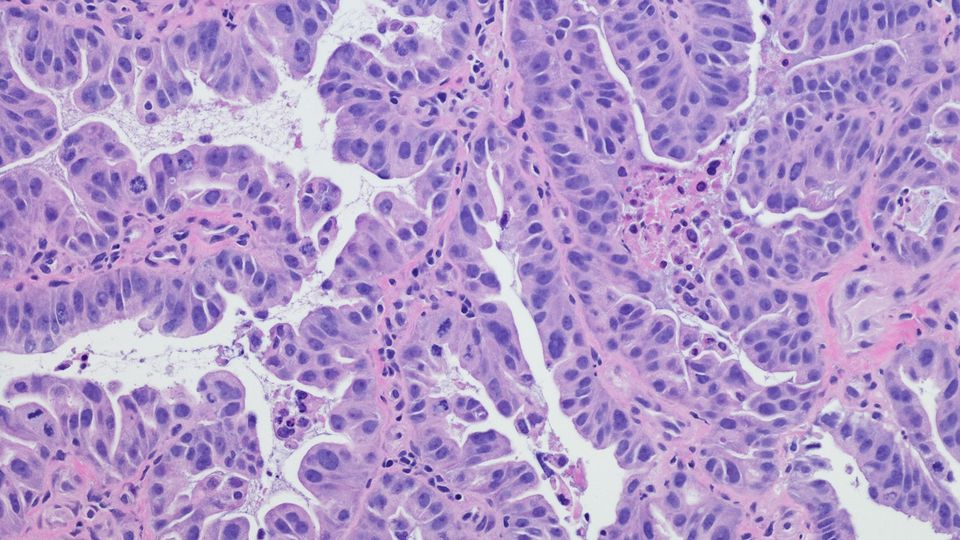 Immunohistochemistry slide image of cancerous tissue.