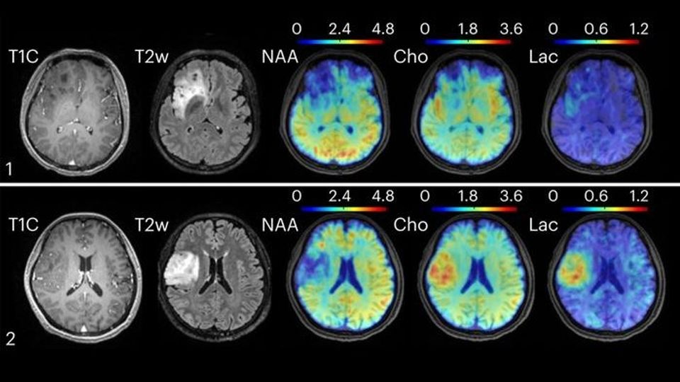 MRI and spectroscopic brain scans comparing two cases of oligodendroglioma brain tumors.