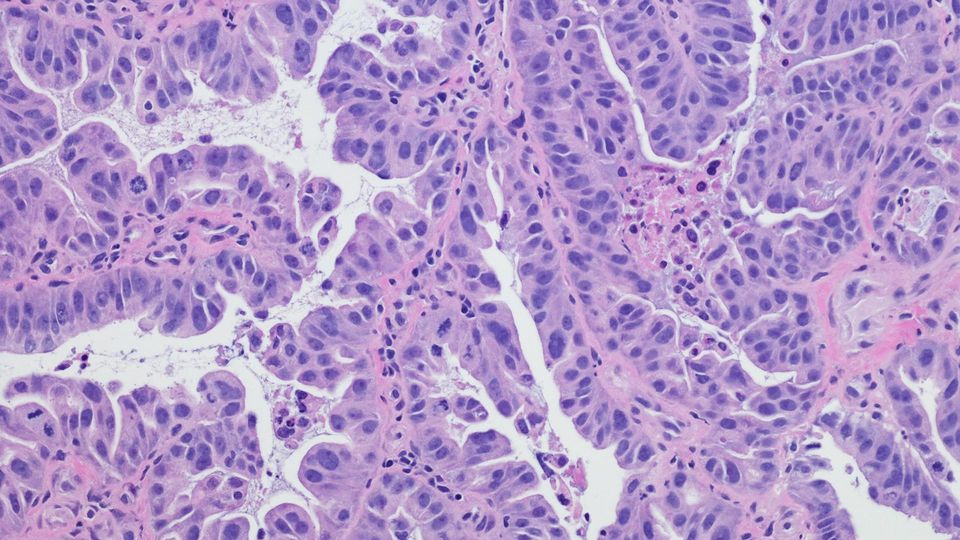 A photograph of stained cancer tissues under a microscope.