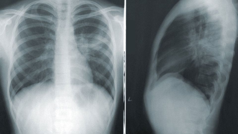 A lung X-ray, illustrating damage to the lungs mitigated by a rare cell type.