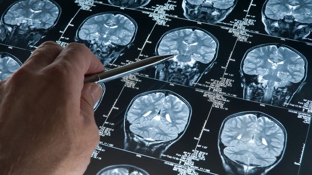A researcher pointing to an MRI image of a human brain showing signs of neurodegeneration. 