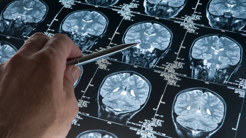 A researcher pointing to an MRI image of a human brain showing signs of neurodegeneration.