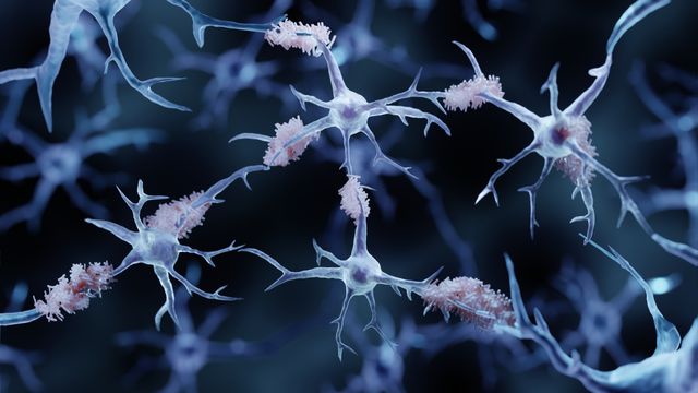 Neurons with beta-amyloid plaques, representing Alzheimer’s disease pathology in the brain.