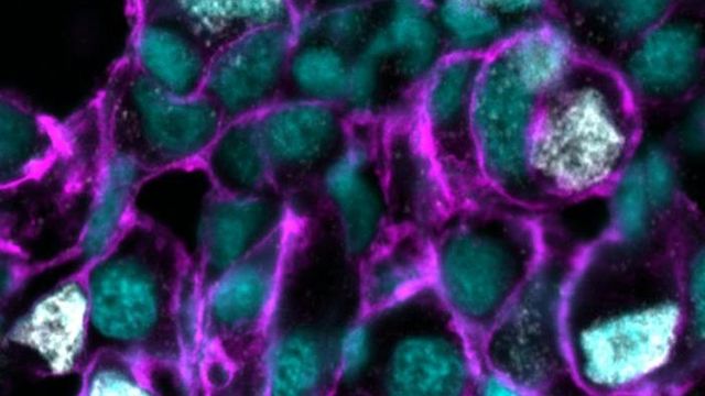 Fluorescent microscopy of zebrafish liver tumor highlighting KRAS activity and DNA damage.