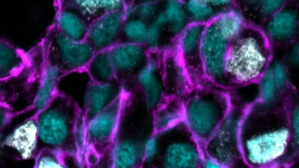Fluorescent microscopy of zebrafish liver tumor highlighting KRAS activity and DNA damage.