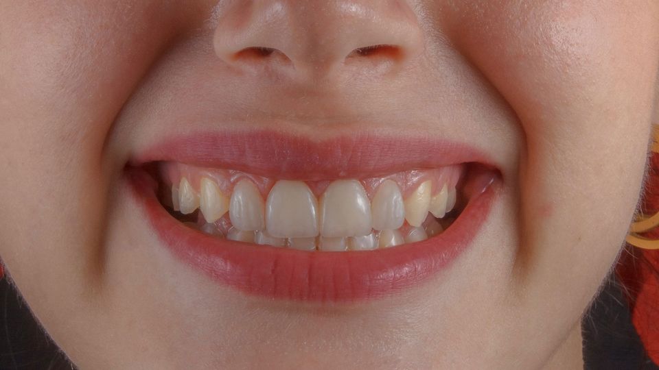 A child grins, showing their teeth.