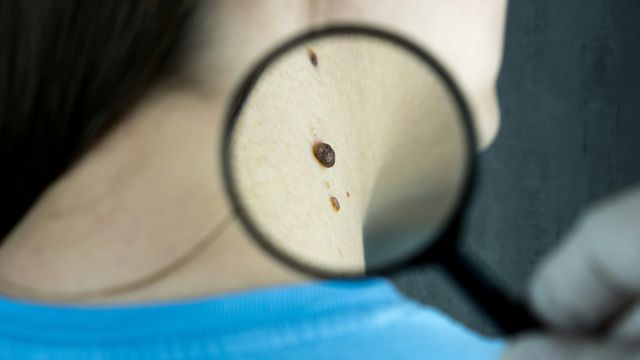 A person examining a mole on a woman's neck, using a magnifying glass. 