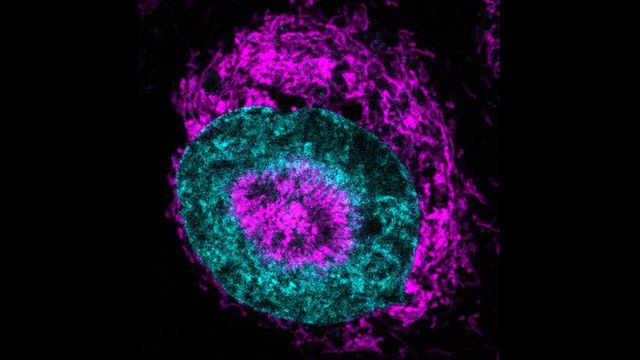 A cancer cell nucleus is surrounded by mitochondria as the cell is squeezed.