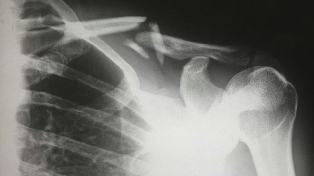 An X-ray of a human shoulder. 