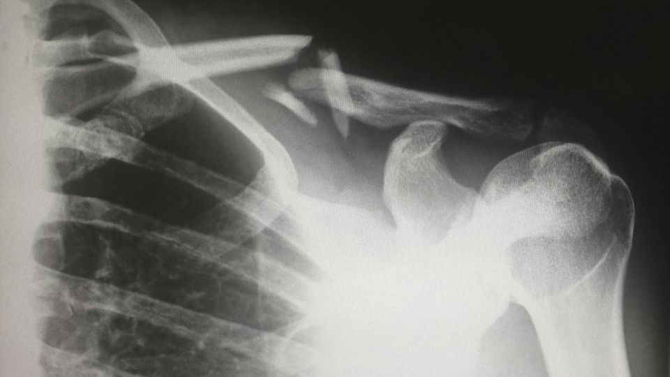 An X-ray of a human shoulder.