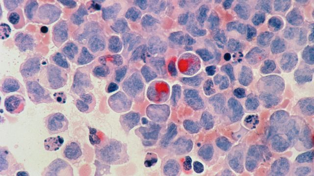 New Endoscopy Technology Improves Early Detection of Esophageal Cancer