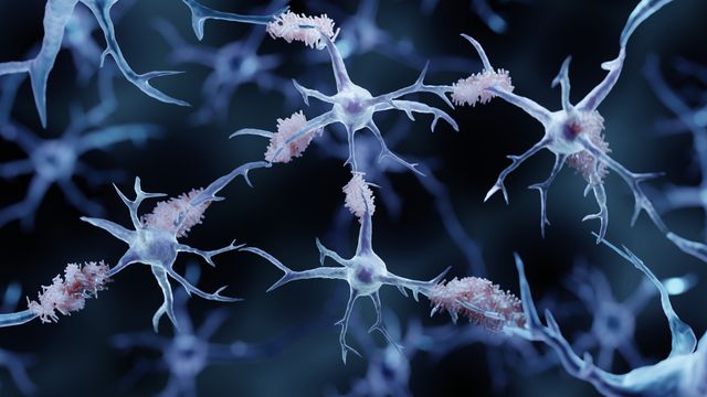 Neurons in the brain with plaques associated with protein buildup in Alzheimer's disease.