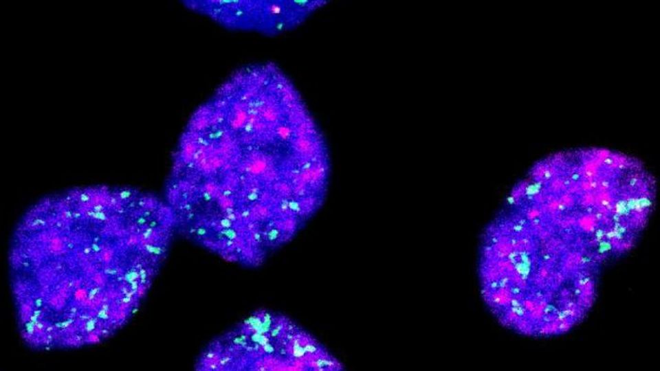 Fluorescent microscopy image of neuroblastoma cells showing bright blue, pink, and green markers against a black background.