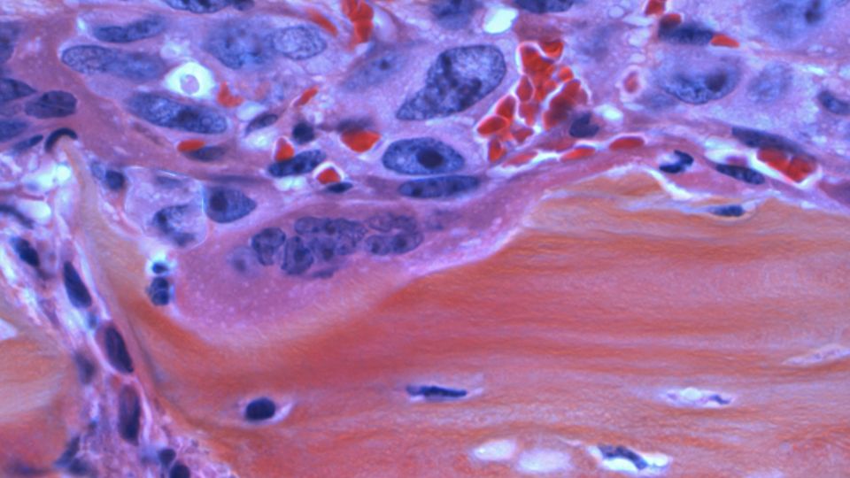 A slide of dyed blue cancer cells near red tissue, seen under a microscope.