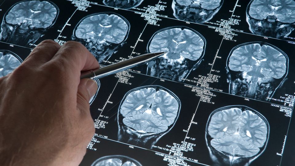 Hand points to brain scan MRI showing areas affected by Alzheimer's disease.