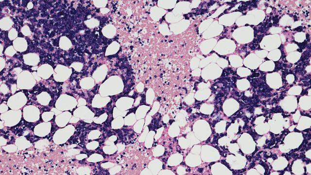 Microscopic view of bone marrow cells used in liquid biopsy research for cancer detection. 