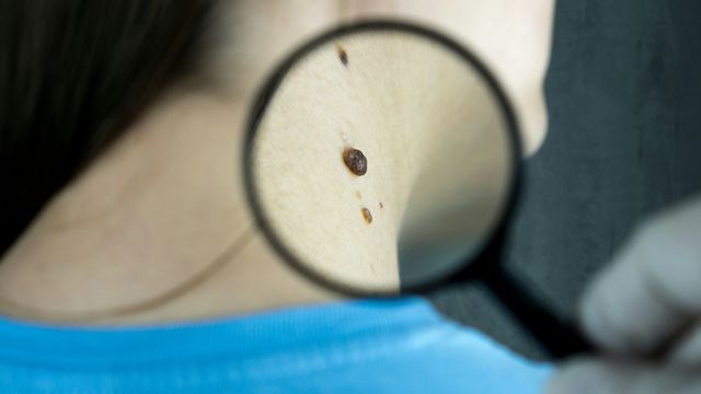 A dermatologist using a magnifying glass to inspect a mole on a woman's neck.