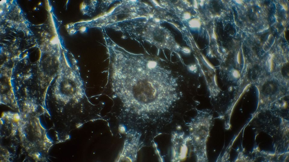 Cancer cells, with molecules visible inside.