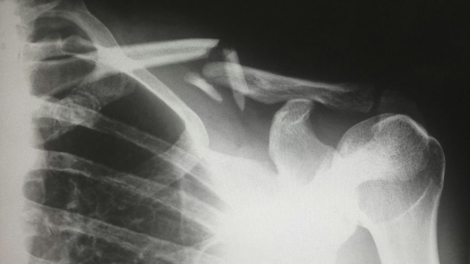 An x-ray of a broken human collarbone.