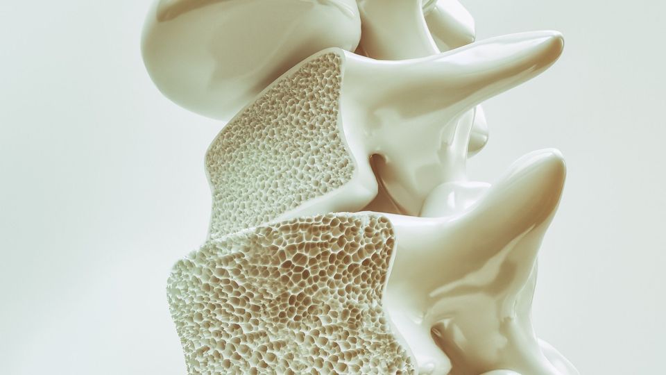 A close up of a human spine with cavities associated with spinal osteoporosis.