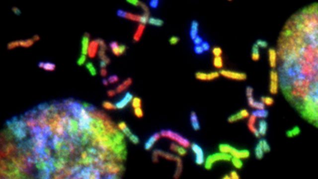 Fluorescent microscopy image of chromosomes in dividing cells, representing genetic mutations linked to brain cancer research. 